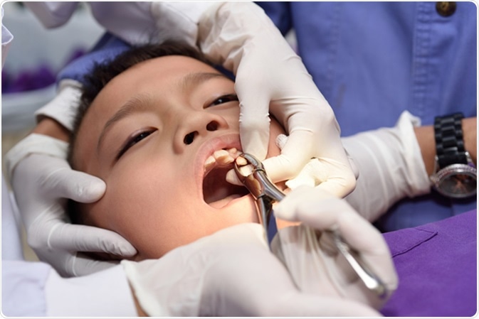 What Are the Complications of a Tooth Removal